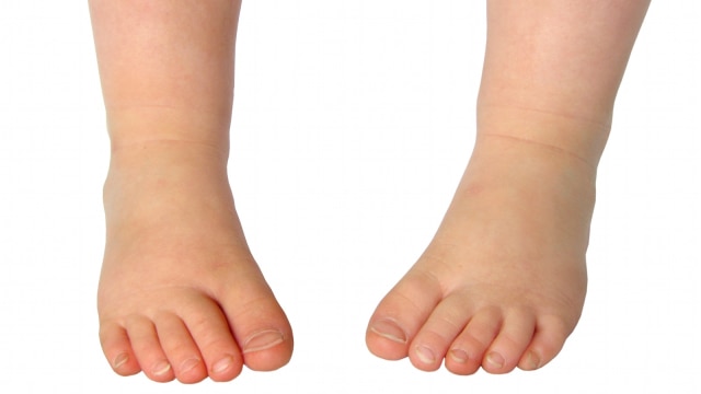Kelainan ortopedi kaki O pada anak (Foto: shutterstock)