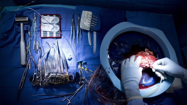 Suasana operasi laparoskopi selama transplantasi ginjal di Rumah Sakit. (Foto: AFP PHOTO / Brendan Smialowski)