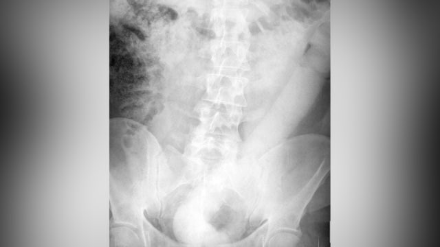 Dildo tersangkut di lubang anus seorang pria di Italia. (Foto: Dok. Tringali, A. et al./BMJ Case Reports)