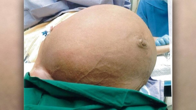 Tumor seberat 28 kilogram (Foto: BMJ Case Reports 2018)