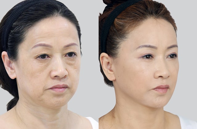 Facelift sering dilakukan pada perempuan paruh baya (Foto: dok. View Plastic Surgery)