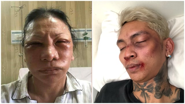 Ratna Sarumpaet dan Young Lex menyebarkan hoax terkait lebam di wajahnya. (Foto: Dok. Istimewa, Instagram @young_lex18)