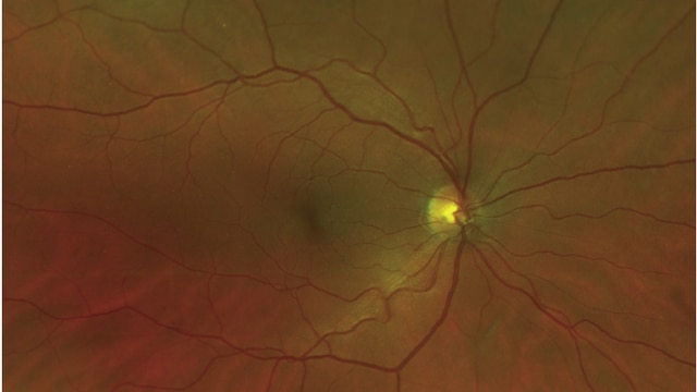 Mata pasien mulai sembuh
 (Foto: Dok:  American Academy of Opthalmology)