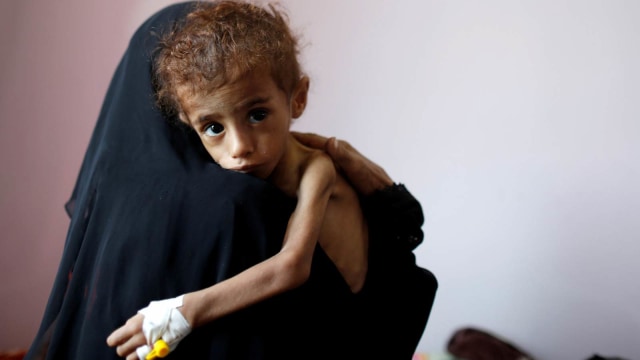 Anak yang kekurangan gizi di Yaman. Foto: REUTERS/Khaled Abdullah