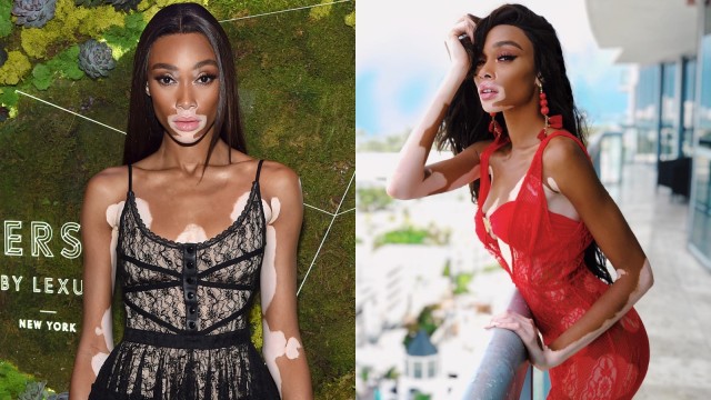 Winnie Harlow (Foto: Dok. Winnie Harlow)