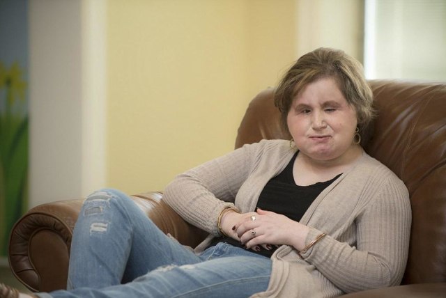 Katie Stubblefield Manusia Termuda Yang Menjalani Transplantasi Wajah Kumparan Com Katie Stubblefield Manusia Termuda Yang Menjalani Transplantasi Wajah Kumparan Com