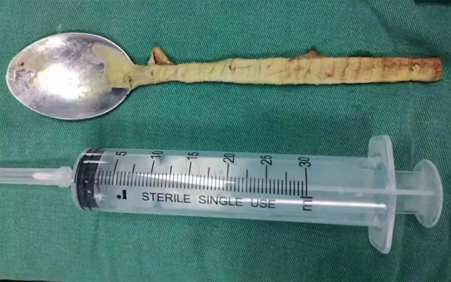 Hasil scan sendok yang tertelan oleh seorang pria (Foto: Xinjiang Meikuang General Hospital)