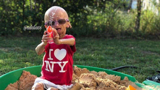 Adalia Rose, bahagia meski menderita progeria syndrome.  (Foto: Instagram/@adalia06)