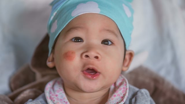 Ilustrasi kondisi kulit bayi. Foto: Shutterstock