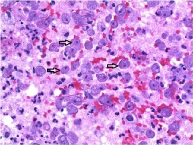 Infeksi ameba di otak. (Foto: International Journal of Infectious Diseases)