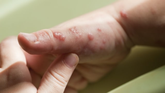 Ilustrasi gejala melepuh akibat infeksi impetigo pada kulit anak (Foto: Shutterstock)