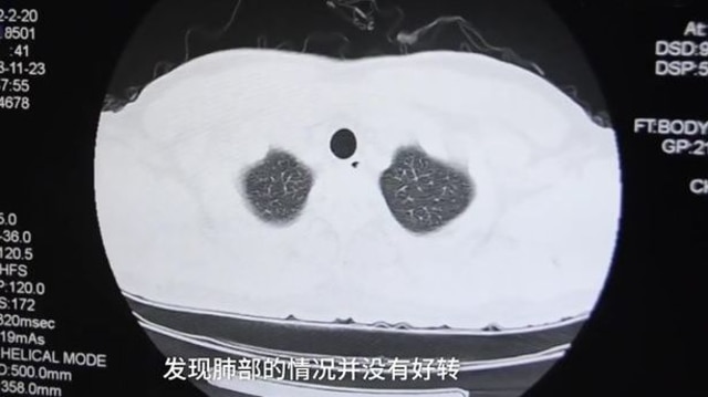 Sering Endus Bau Kaus Kaki, Pria di China Ini Alami Infeksi Paru-paru (1)
