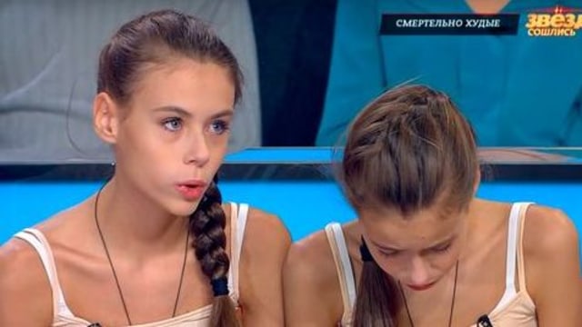 Model Remaja Kembar Asal Rusia Ini Sekarat karena Terlalu Kurus (2)
