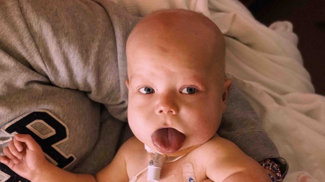 Bayi bernama Baker Roth menderita Beckwith-Wiedemann. (Foto: Dok. Farrah Roth via GoFundMe)
