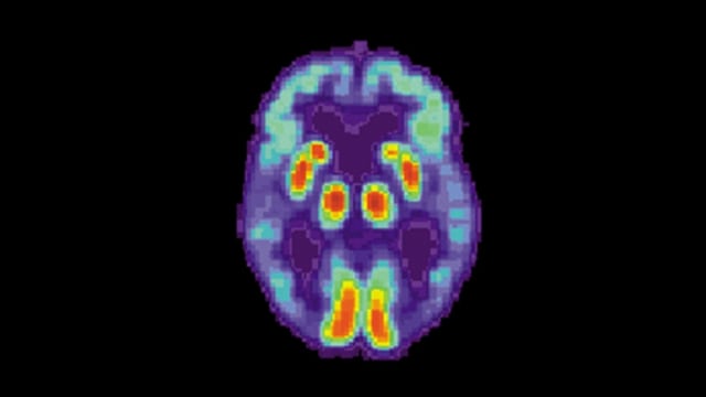 Pemindaian PET pada otak pasien penderita alzheimer. (Foto: National Institute on Aging)