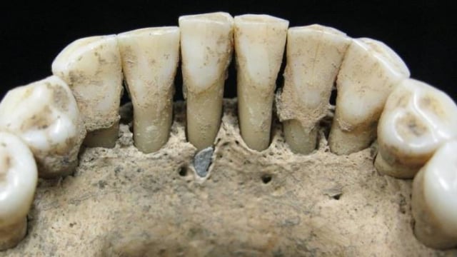 Fosil gigi wanita dari abad pertengahan (Foto: Christina Warinner)