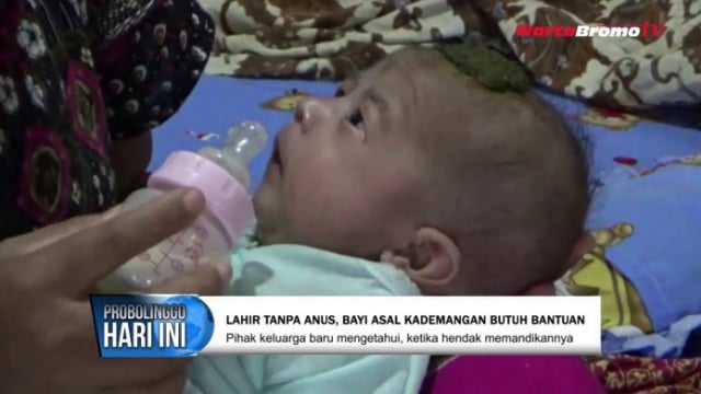 Bayi Tanpa Anus di Probolinggo Akhirnya Dapat Bantuan