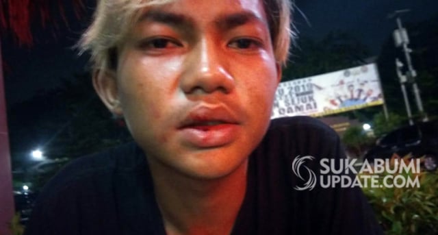 Rizky (18), salah satu fans band Slowly Project asal Kota Sukabumi yang mengalami luka di bagian lutut dan wajah akibat pengeroyokan oleh sejumlah suporter bola pada hari Minggu malam (13/1/2018) di JK7 Bar Club Hotel Arion, Kemang Mampang Prapatan. (Foto: Istimewa)