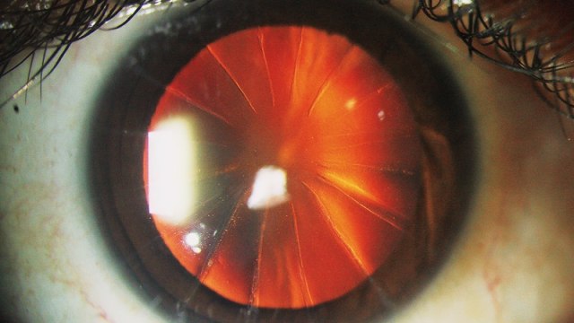 Sayatan di mata seperti pizza yang muncul setelah operasi. (Foto: Sahib Y. Tuteja et al/The New England Journal of Medicine)