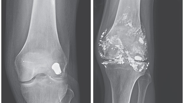 Peluru bersarang di lutut selama 14 tahun, hingga akhirnya pecah. (Foto: Jose I Marquez/Michael A Schindlbeck via The New England Journal of Medicine )