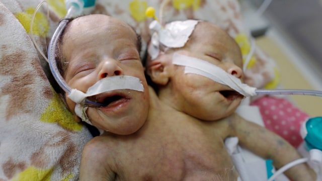Bayi kembar siam di yaman mendapatkan perawatan khusus di unit perawatan intensif anak di rumah sakit al-Thawra di Sanaa, Yaman. Foto: REUTERS/Khaled Abdullah