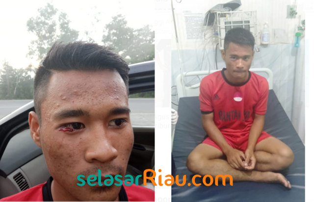 NURUL Ilham Rezkianda, pemain U17 Bantan FC dengan luka di bagian bawa mata sebelah kanannya.  