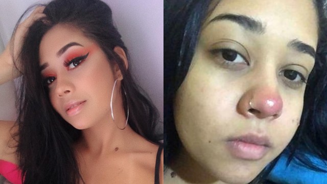 Gadis adal Brasil lumpuh setelah tindik hidung. (Foto: Instagram/@layaanedias dan CEN/Layane Dias)
