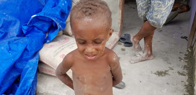 Andy, anak penderita gizi buruk yang berusia 3 tahun. Foto: BalleoNews