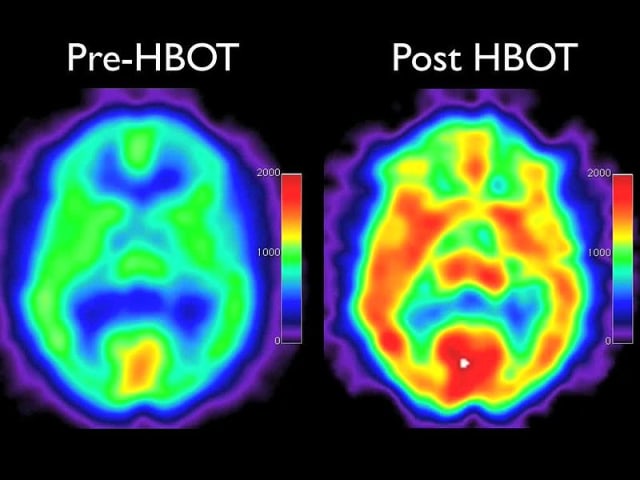 Low-pressure-hyperbaric-oxygen-therapy-and-SPECT-brain-imaging-in-the-treatment-of-blast-induced-1757-1626-0002-0000006538-S1.ogv.jpg