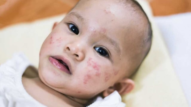 Perawatan Kulit Bayi Dermatitis Atopik Kumparan Com