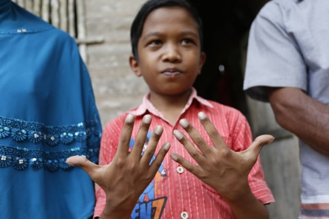 Rifki, anak dengan kelainan jantung sejak lahir memperlihatkan tangganya. Foto: ACT Aceh 