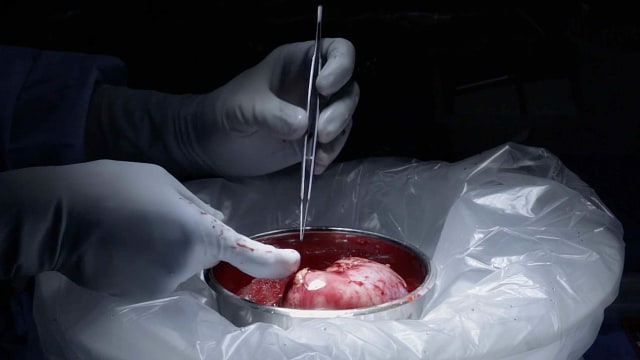 Transplantasi Ginjal dari ODHA. Foto: AP