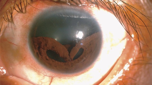 Iris mata seorang pria terlepas dari tempat seharusnya. Kondisi ini disebut iridodialysis. Foto: The New England Journal of Medicine