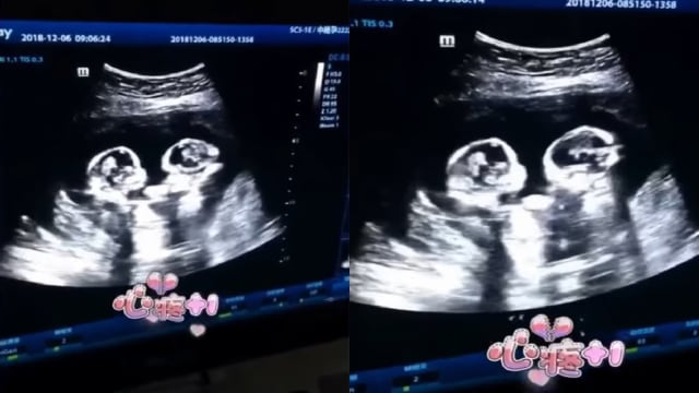 Janin kembar di China terlihat seperti berkelahi di dalam rahim ibunya. (foto: YouTube/抖音精选)