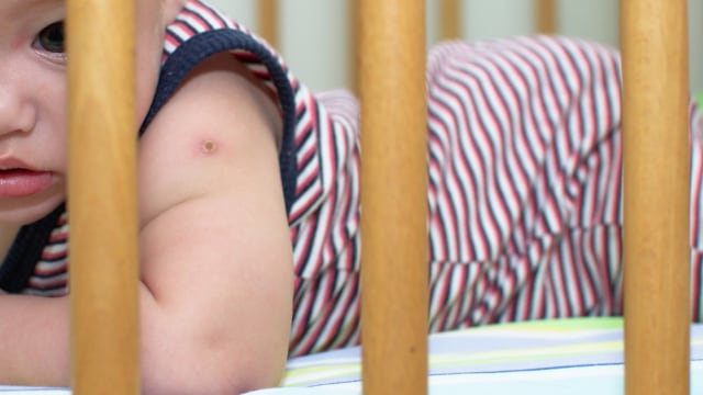 Ilustrasi luka bekas imunisasi pada lengan bayi. Foto: Shutter Stock