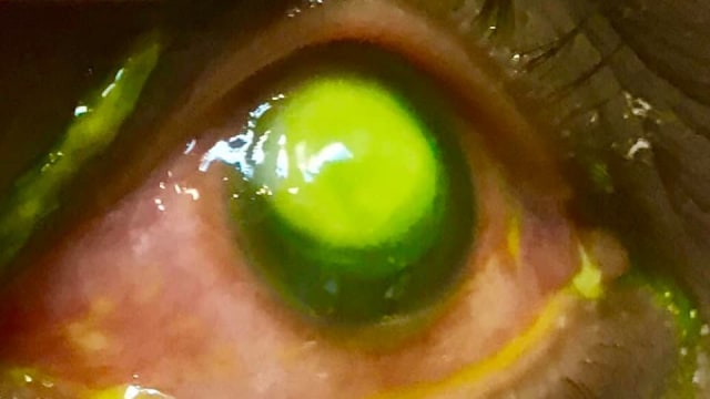 Mata seorang pasien di klinik mata Vita Eye Clinic di North Carolina, terinfeksi bakteri Pseudomonas karena sering memakai lensa kontak saat tidur. Foto: Dok. Vita Eye Clinic