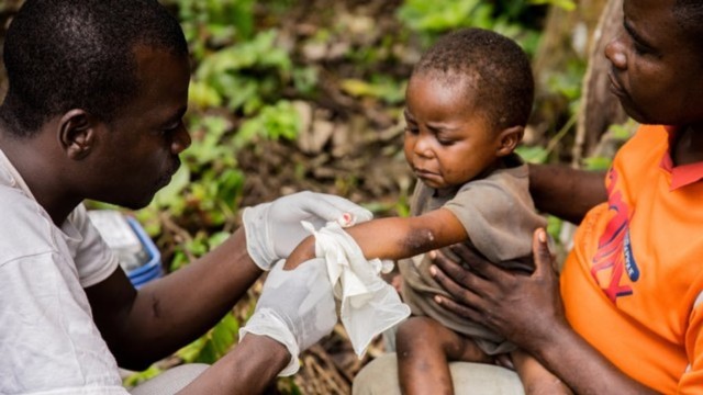 Seorang anak terinfeksi Monkeypox di Afrika, yang mendapatkan pengobatan. Foto: AFP