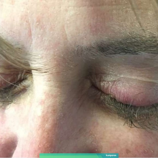 Wanita 45 tahun ini mengalami efek samping pengobatan kanker cetuximab, antara lain pengeritingan, pigmentasi, atau pemanjangan bulu mata. Foto: Journal BMJ