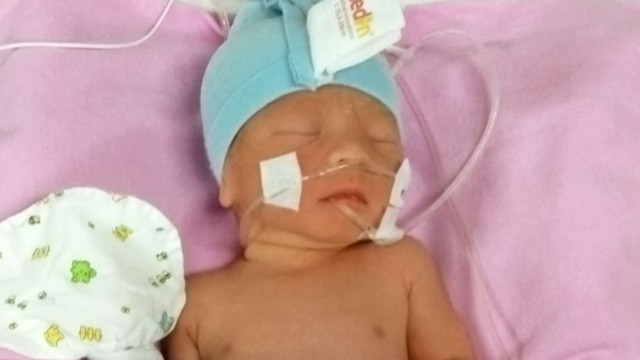 Perjuangan Saya Dan Bayi Kembar Yang Lahir Di Usia Kandungan 8 Bulan Kumparan Com