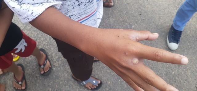 Seorang anak yang menjadi korban serangan ulat bulu, di Pangkalpinang.