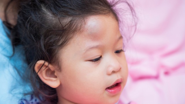 Ilustrasi benjol pada kepala anak. Foto: Shutter Stock