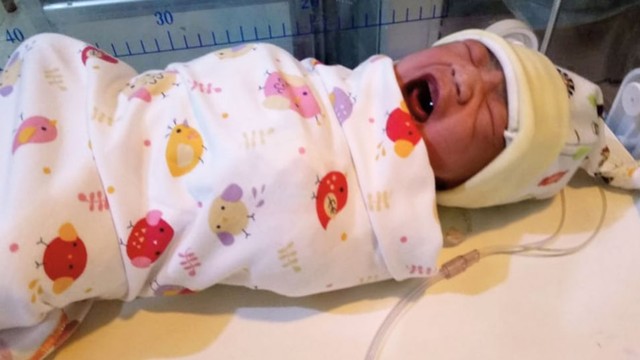 Bayi dengan Hiperbilirubinemia Tidak Selalu Memerlukan Terapi Sinar