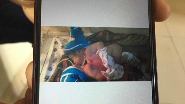 Bayi kembar siam di RSUP Sanglah, Kadek Rudita