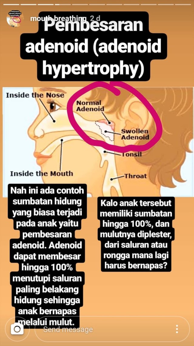 Penjelasan Dewi Boedhiyono terkait blokade pernapasan