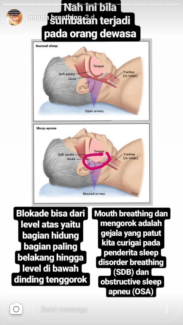 Penjelasan Dewi Boedhiyono terkait blokade pernapasan