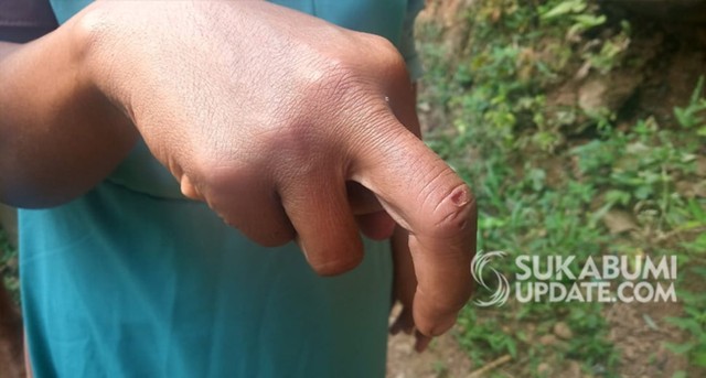 Mimin saksi KDRT di istri bacok suami di Cikidang Sukabumi memperlihatkan luka dijari tangannya. | Sumber Foto:Ruslan AG.