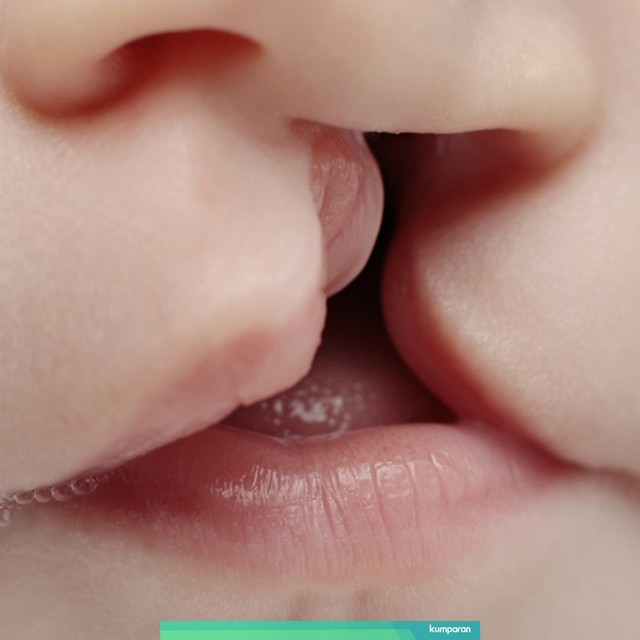 Ilustrasi bayi dengan bibir sumbing Foto: Shutterstock