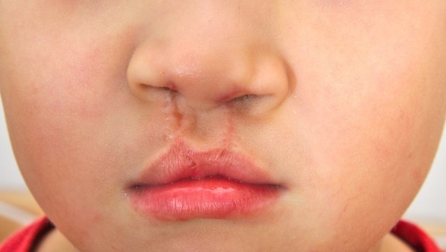 Hasil operasi bibir sumbing Foto: Shutterstock