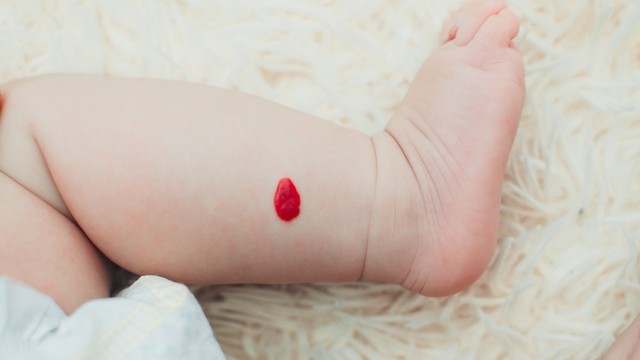 6 Jenis Tanda Lahir pada Bayi (78458)