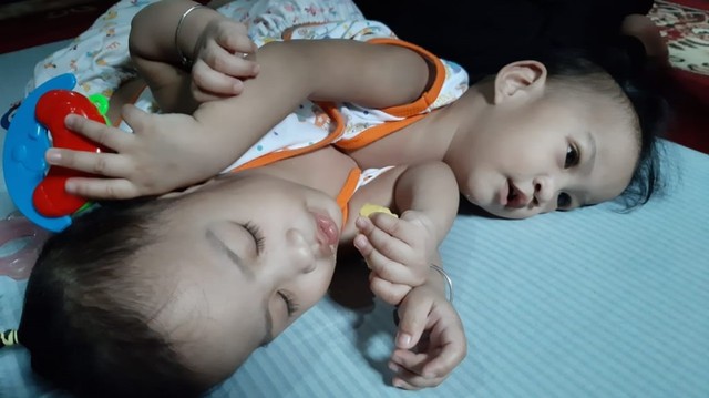 Batita Kembar Siam Asal Kendari Akan Berangkat Ke Surabaya 1 Agustus Kumparan Com
